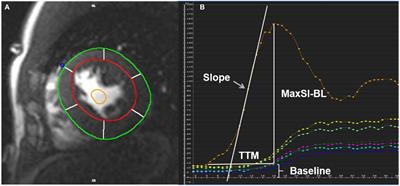 The major factor of left ventricular systolic dysfunction in patients with cardiac amyloidosis: Amyloid overload or microcirculation impairment?